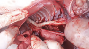 calcificacion-aorta